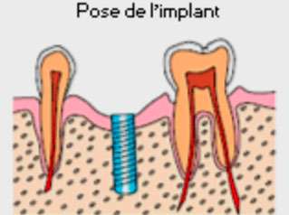 Schema de pose d'un implant dentaire